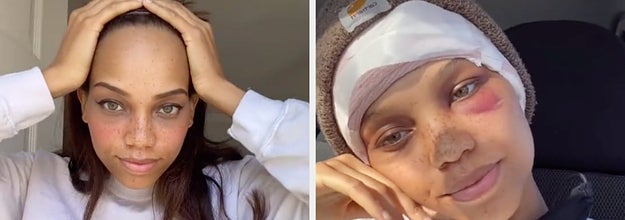 A before and after of the forehead surgery