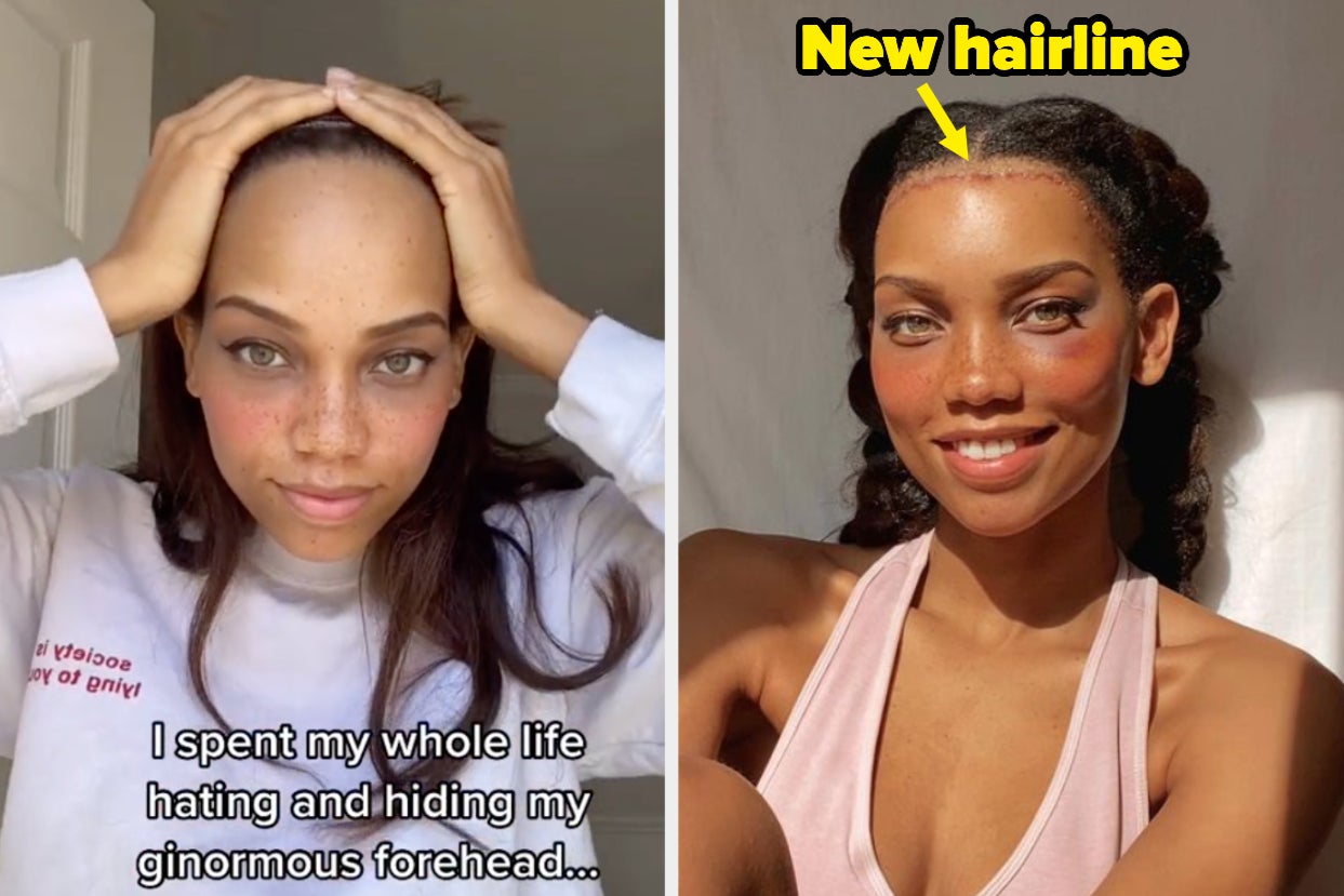 This Woman On TikTok Got Forehead Reduction Surgery, And People Have A ...