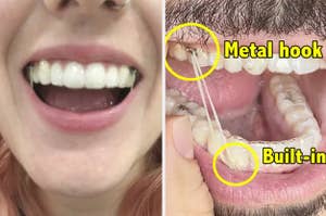 Closeup of shelby and pablo's teeth with invisalign trays, rubber bands, and metal hooks