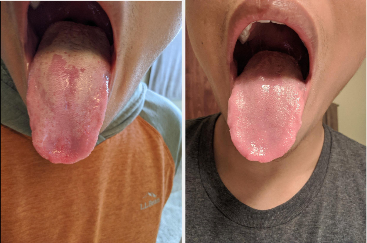 Reviewer before image with film on tongue and after image of clean tongue 