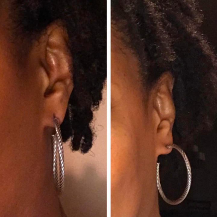 Reviewer with mid-sized, heavy hoops pulling at earlobe before use and sitting naturally on earlobe after 