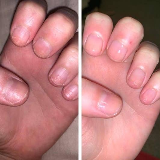 A reviewer before and after photo showing cracked nails and then soft, shiny nails