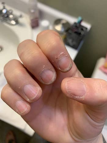 A reviewer showing off their dry, cracked cuticles before using the serum