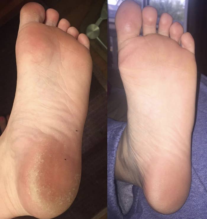 a foot before and after the peel mask