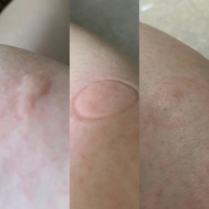 a triptych of a reviewer's fresh and large bug bite, the bite surrounded by a ring after using the tool, and then the bite almost totally flat and faded
