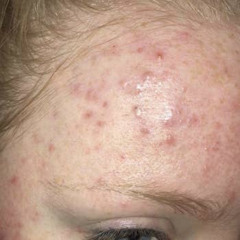 A customer review photo of the texture on their forehead before using the chemical exfoliant