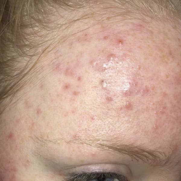 a idiosyncratic with texture connected their forehead earlier utilizing the chemic exfoliant