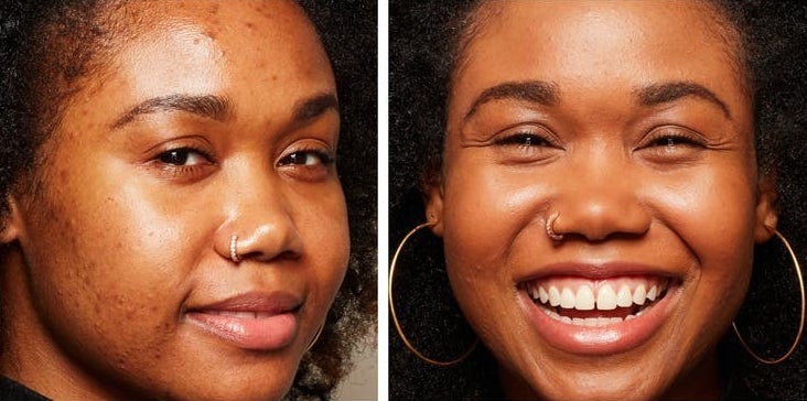 A model before and after applying the product in Rich Honey, with blemishes covered