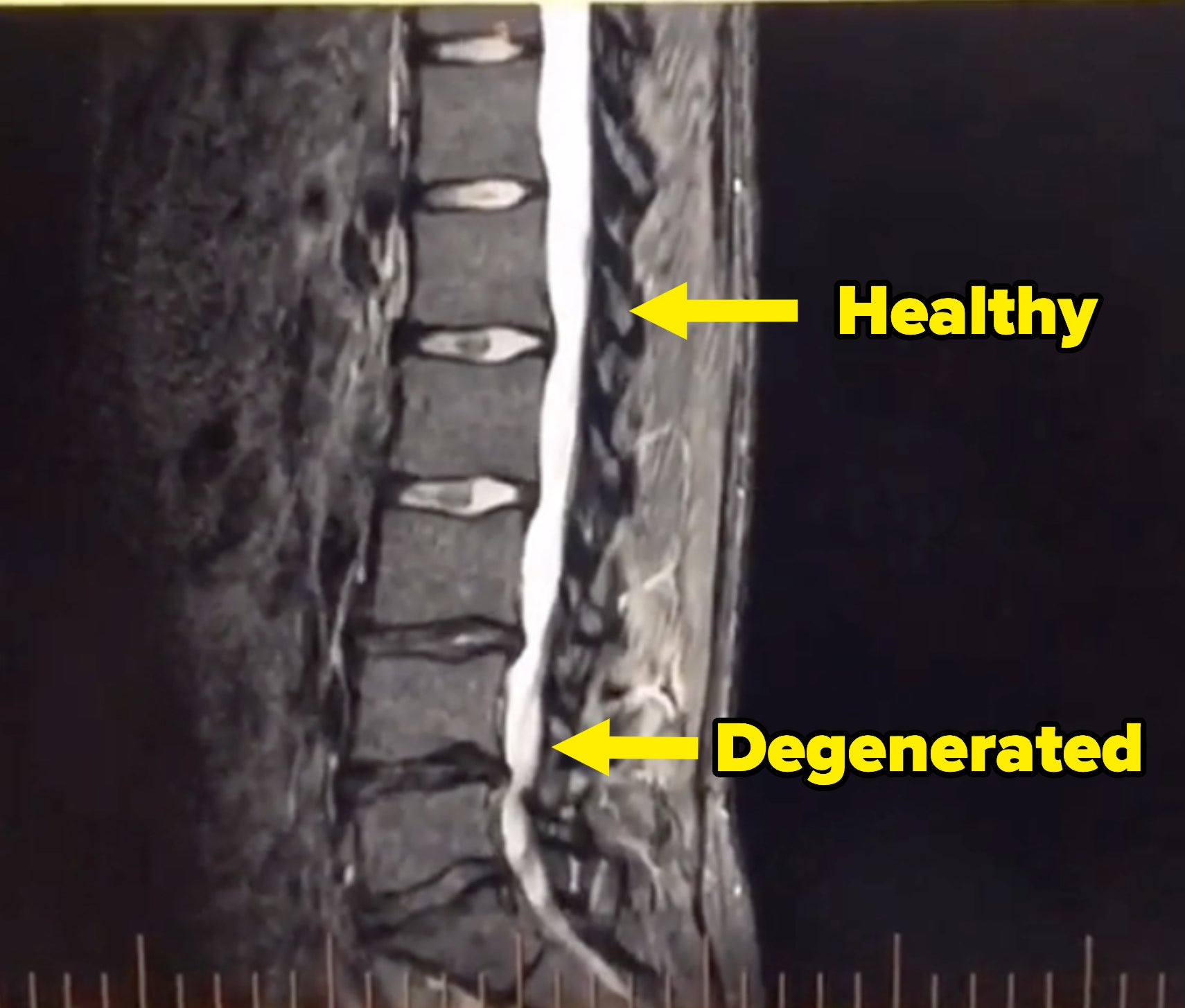 An arrow pointing to a healthy disc and one pointed to a degenerated disc that looks flatter