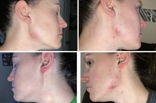 reviewer on right with visible acne and less visible acne on left