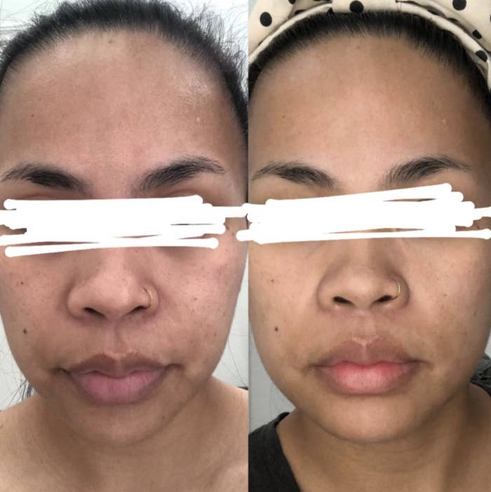 reviewer with visible scarring on left and less visible scarring on right