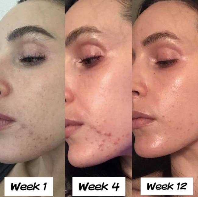 reviewer showing week 1, week 4, and week 12 using product with acne becoming visibly less apparent in each picture 