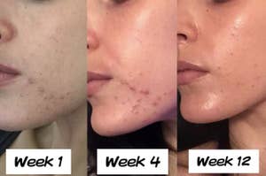 reviewer showing week 1, week 4, and week 12 using product with acne becoming visibly less apparent in each picture