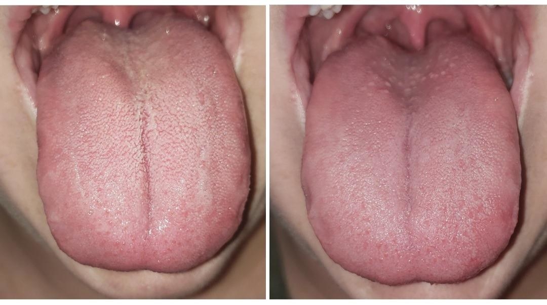 calculus buildup on bar of my tongue ring