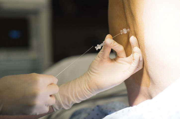 Close up of epidural needle going into a back.