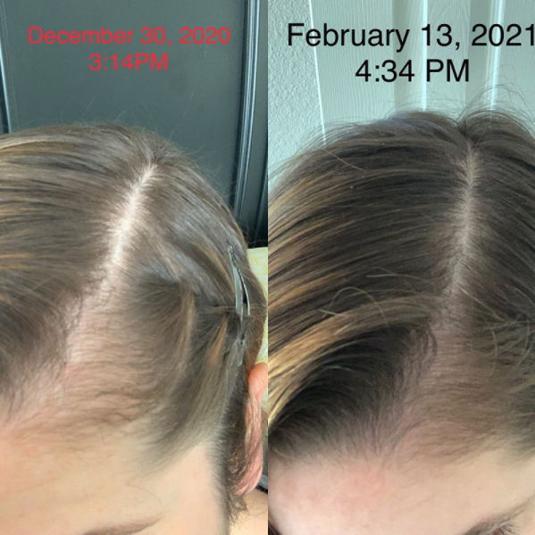 reviewer&#x27;s photo before using product on the left and after using the product for two months on the right, shows hair growth  