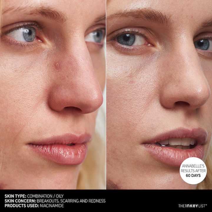 Model before and after using the product, skin is clear in the after photo