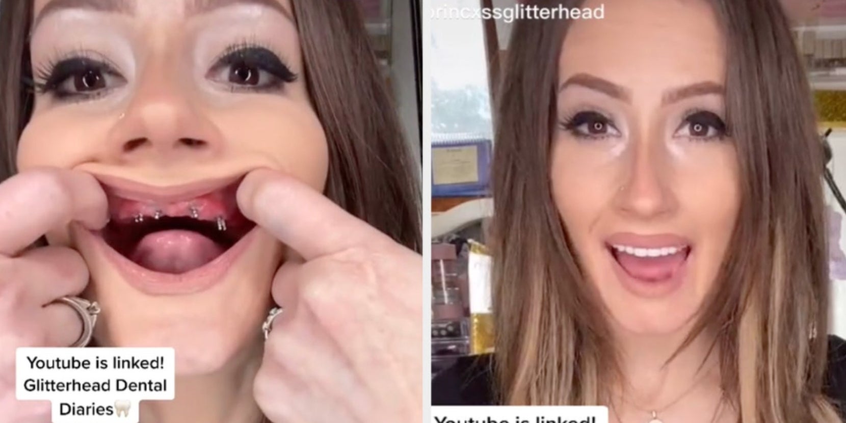 TikTok Users Making Risky DIY Dentures, Teeth Out of InstaMorph Beads
