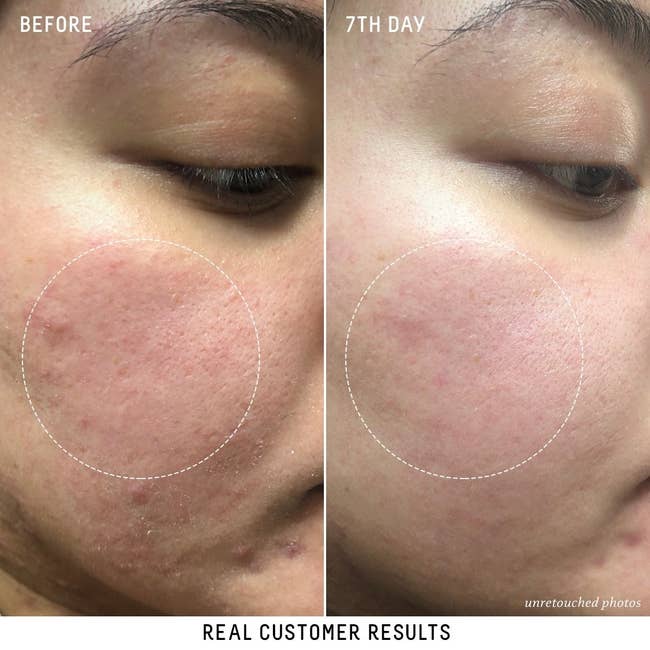 before image of customer's cheek with redness and bumps, and after image showing less redness and bumps