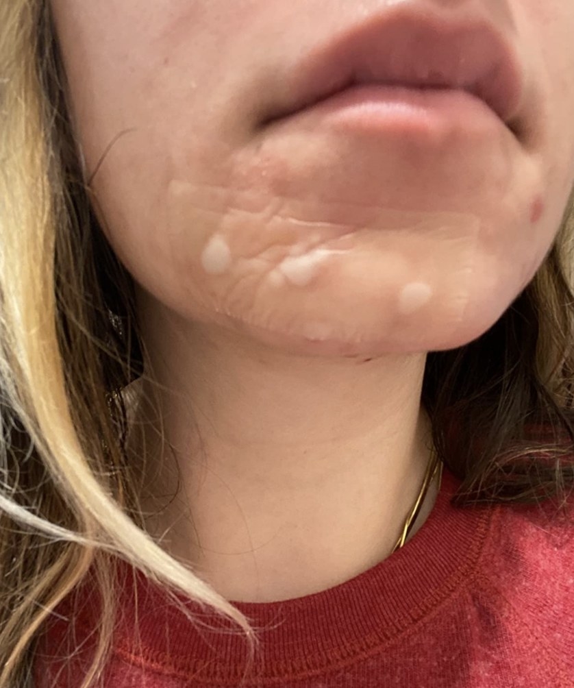 A person wearing the acne patch