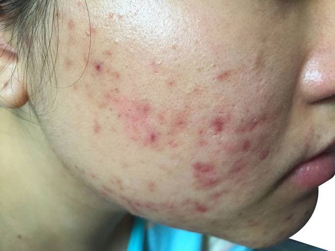 Close up of acne on face