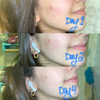 Progression photos showing redness and acne on reviewer's cheeks is reduced on day 2 and day 4