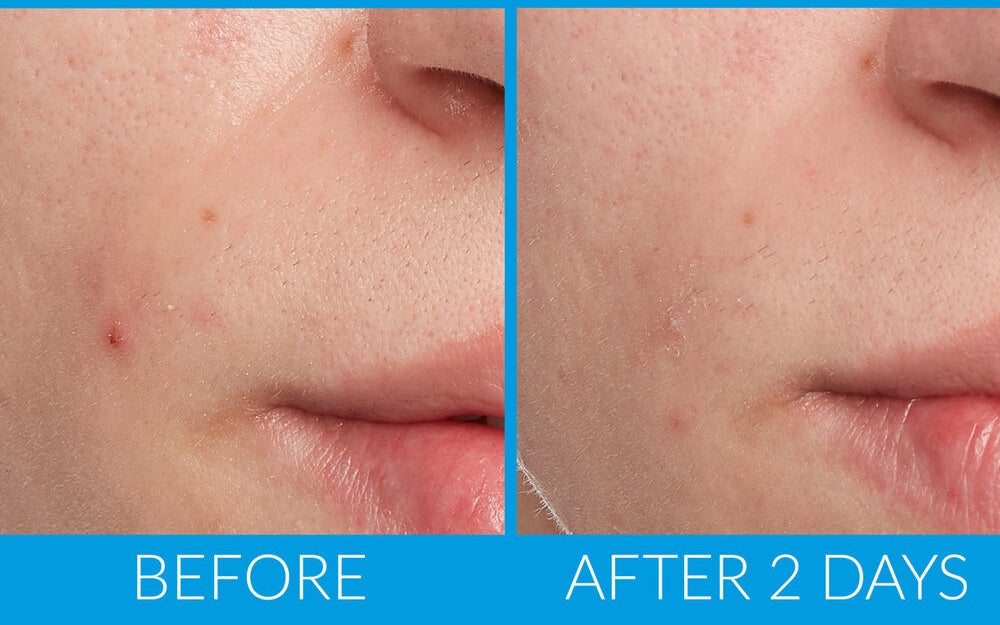 before/after showing model with small blemishes and then gone after two days