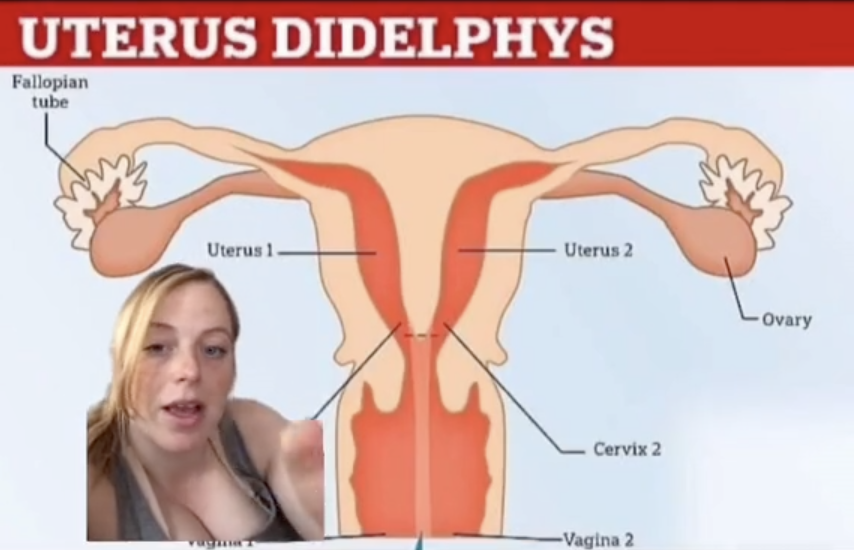 Brittany in front of a diagram of uterus didelphys