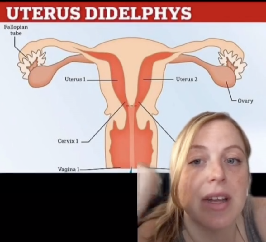 Brittany in front of a diagram of uterus didelphys