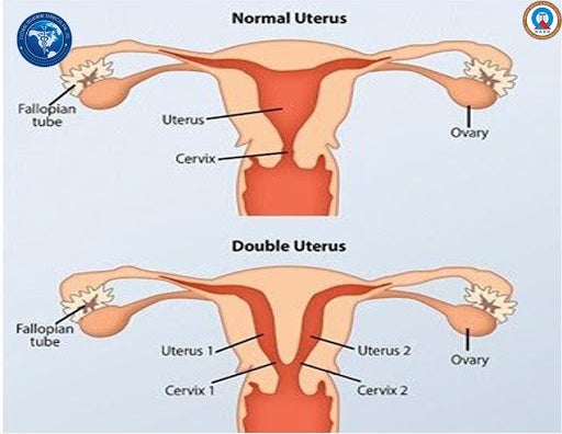 A diagram of a normal uterus and a double uterus