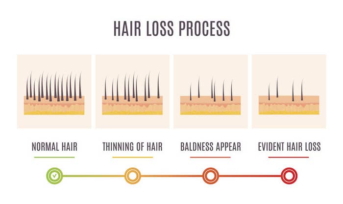 Stages of thinning hair chart