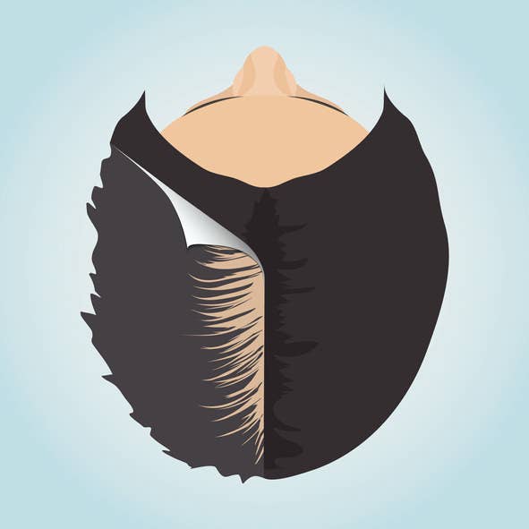 Hair loss thinning overhead of women