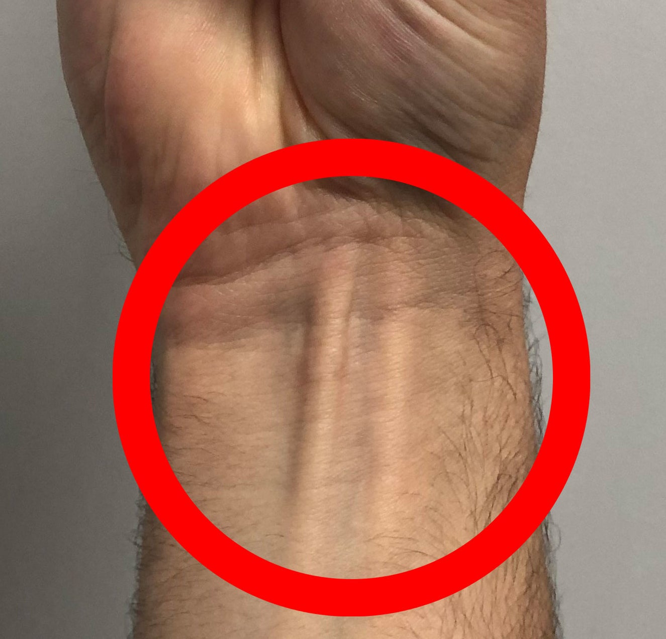 The palmaris longus visible in the wrist