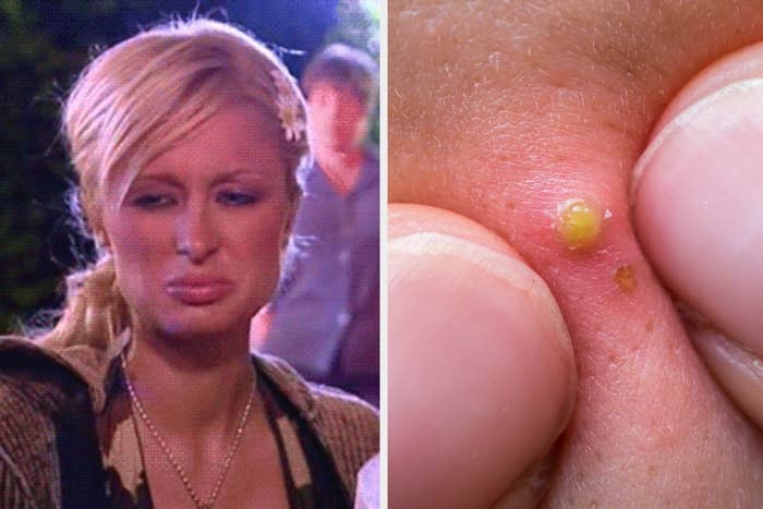 Paris Hilton and pimple
