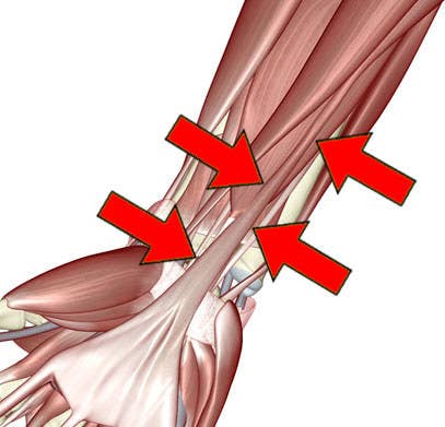 A diagram of a muscles in the arm with the palmaris longus labeled in the center of the wrist and the forearm