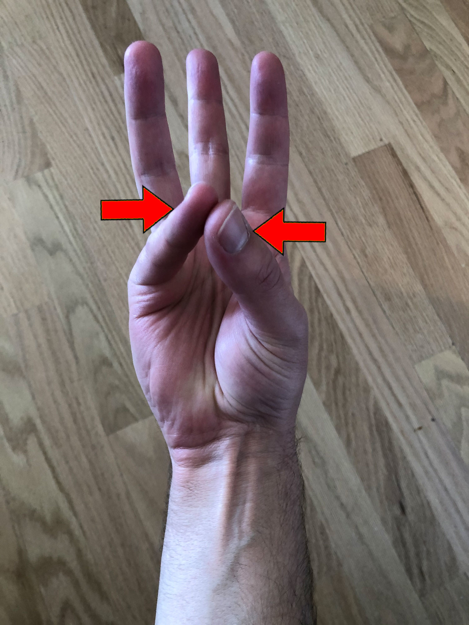 The palmaris longus sticking out of my wrist