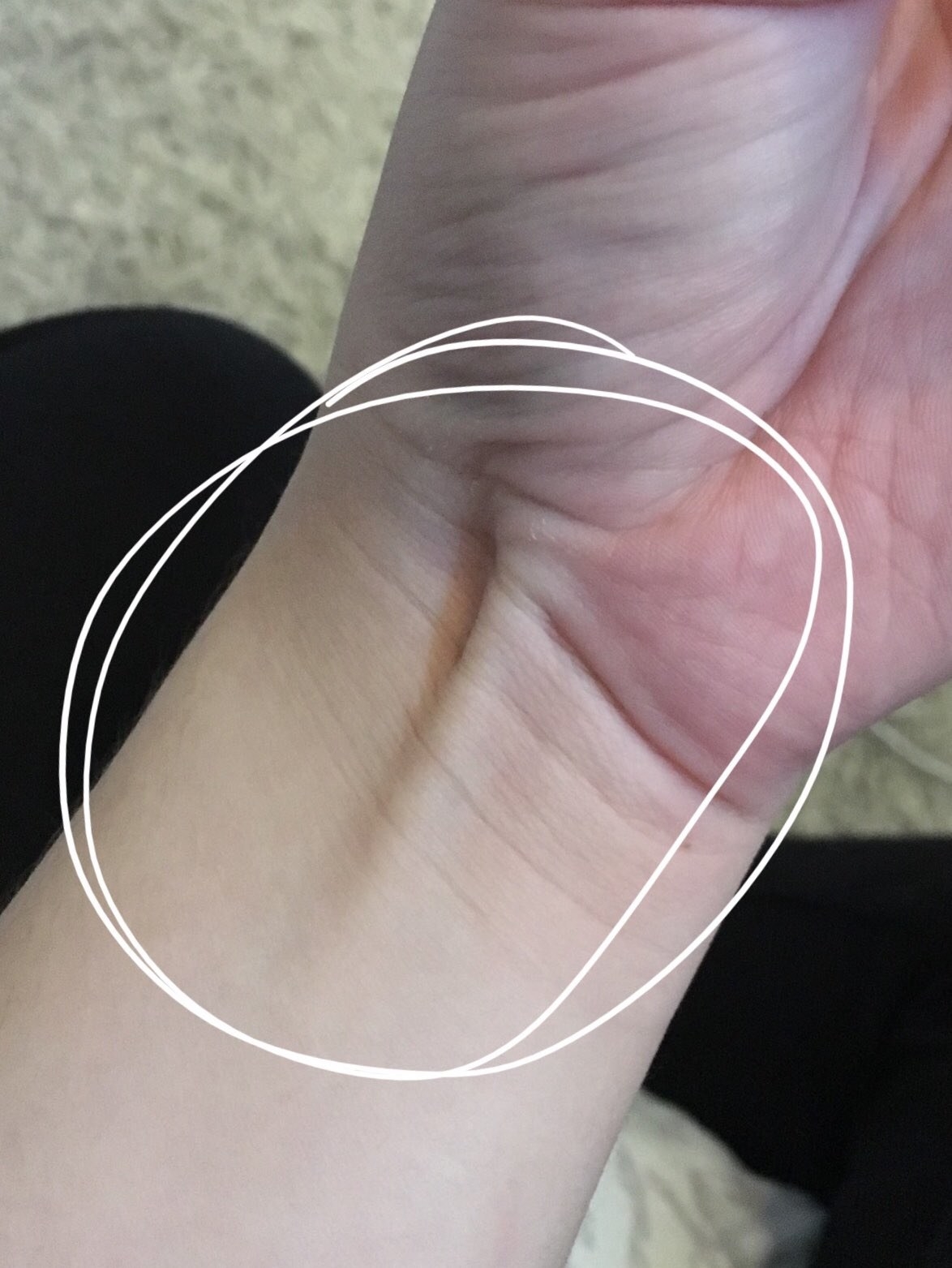 The palmaris longus with a big circle around it