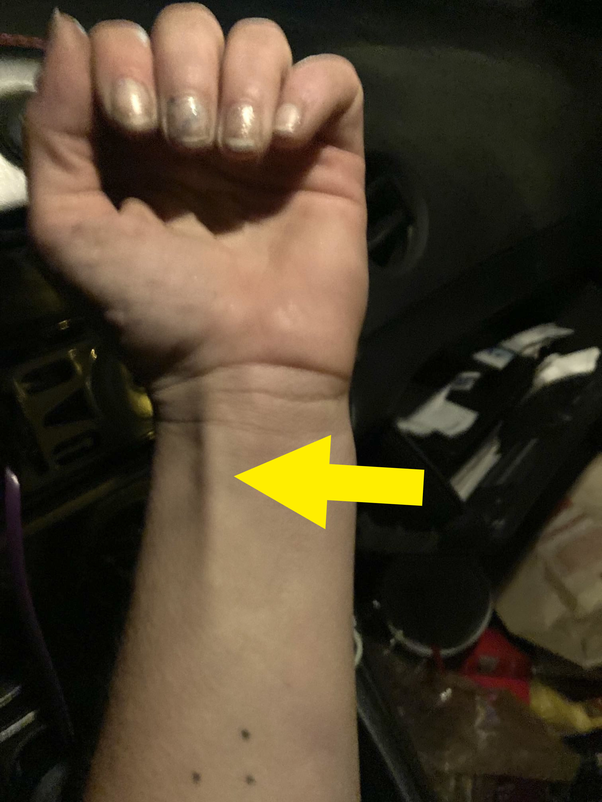 A palmaris longus on a different arm