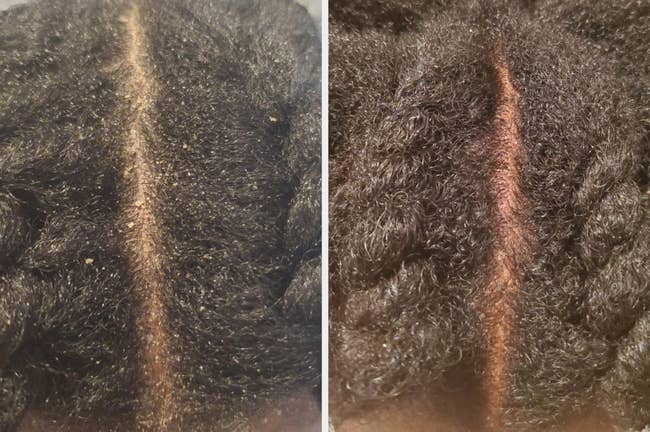 before and after image of reviewer with dandruff on their scalp and without 