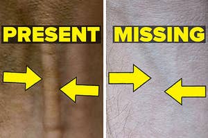 The palmaris longus present in one arm but absent in another arm