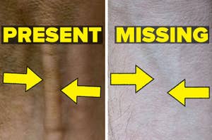 The palmaris longus present in one arm but absent in another arm