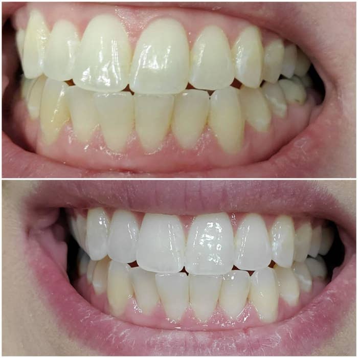 a split before and after image of a reviewers yellow teeth before the whitening pen and their teeth appearing whiter after use 
