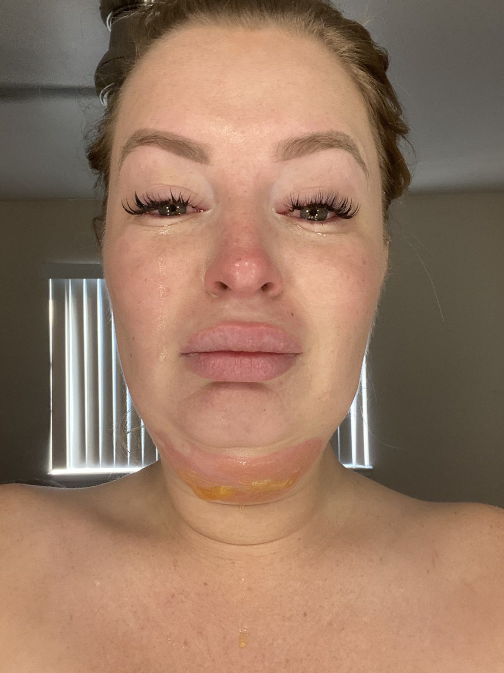 Victoria Quezada Goes Viral For Fat Freezing Mishap