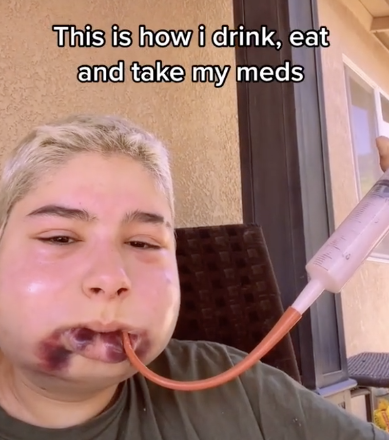 Reyna eating and drinking through a tube, that&#x27;s attached to a syringe plunger, and placed in their mouth