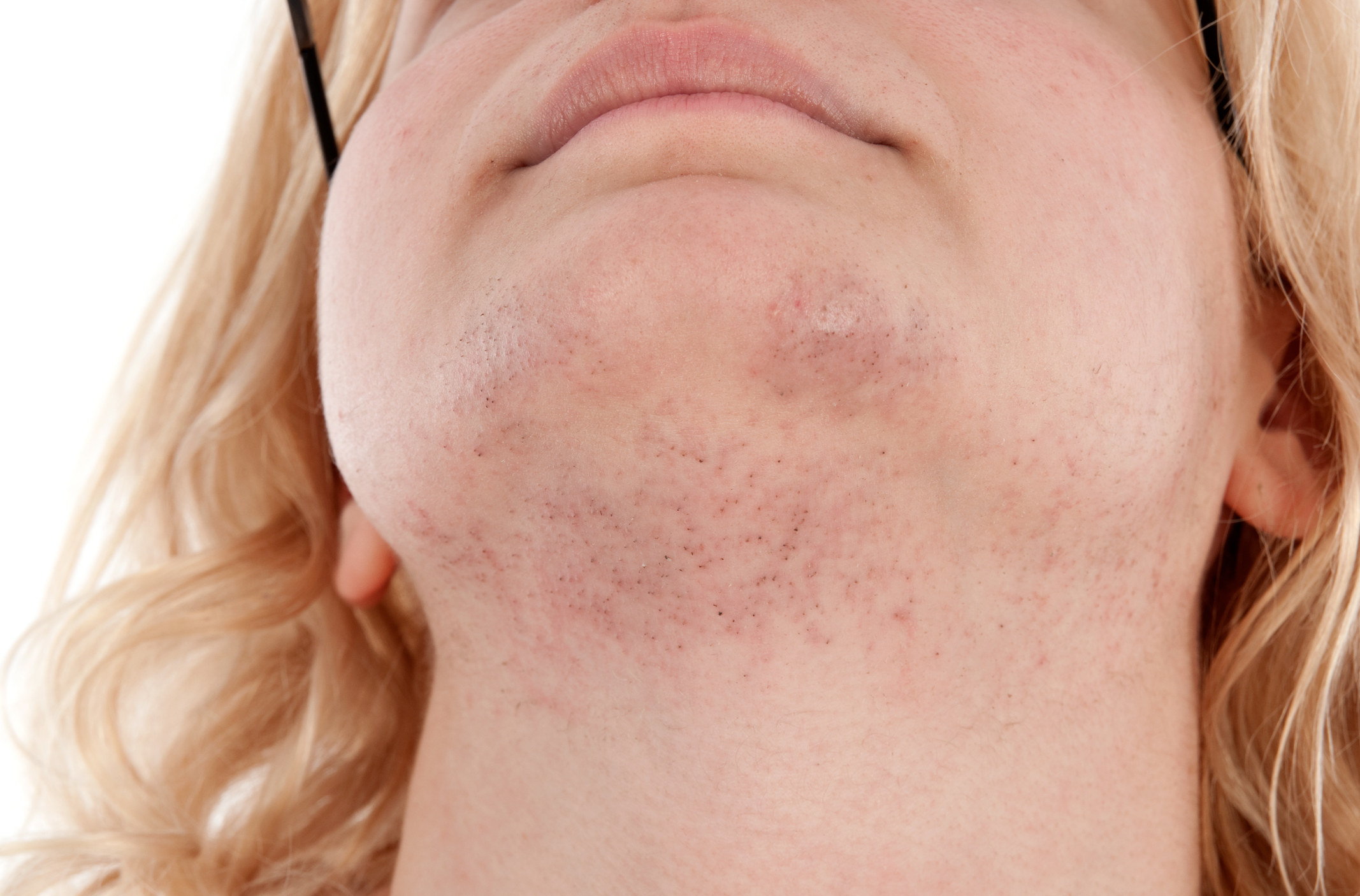 A closeup of a woman&#x27;s chin hair