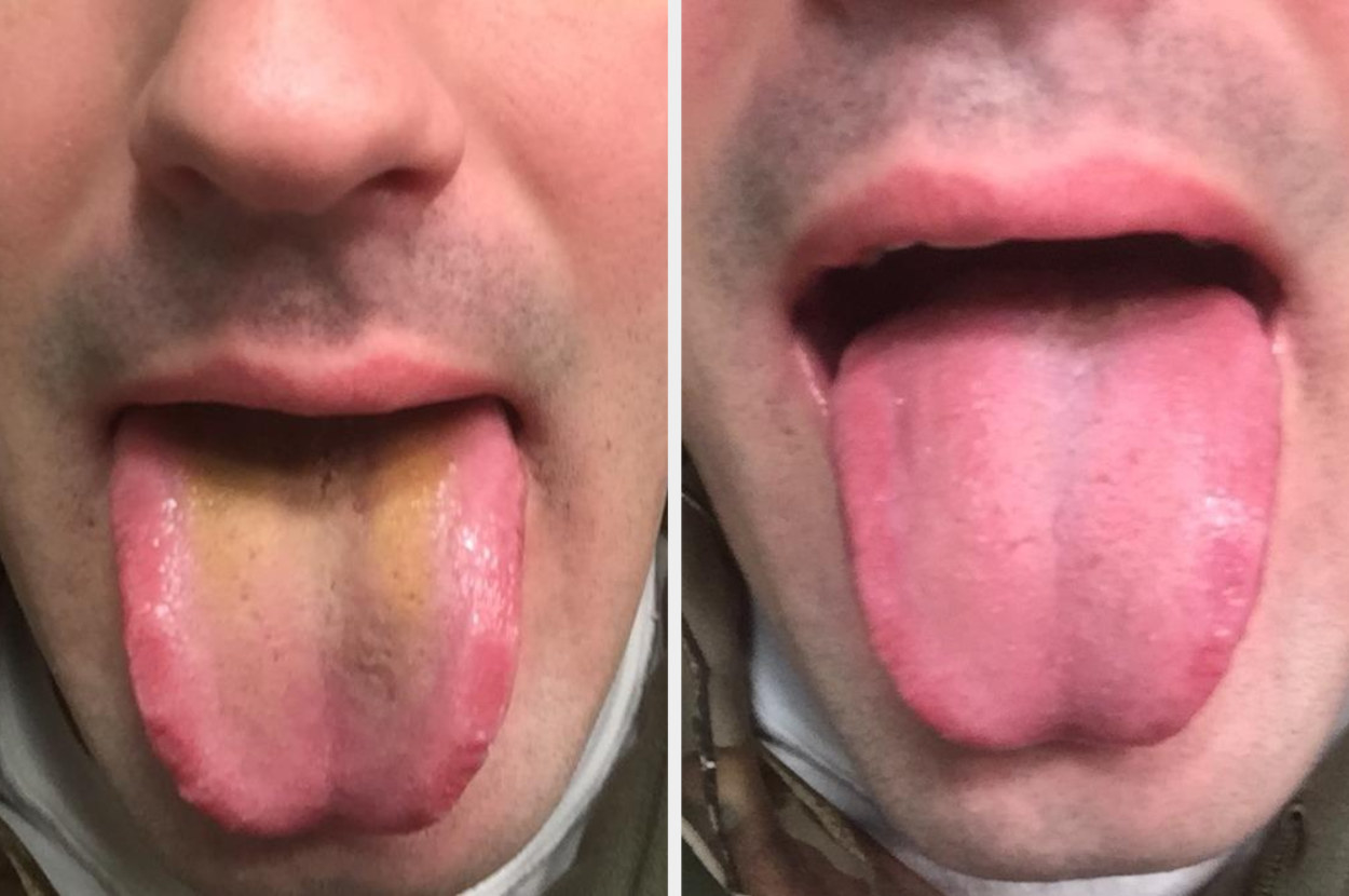 reviewer&#x27;s before pic with yellow gunk on their tongue / the after pic with their tongue looking clean  