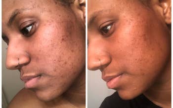 side by side before and after images of Black reviewer with dark spots and acne on the left and clearer skin on the right