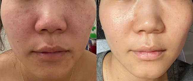 side by side before and after images of Asian reviewer with dark spots and acne on the left and clearer skin on the right