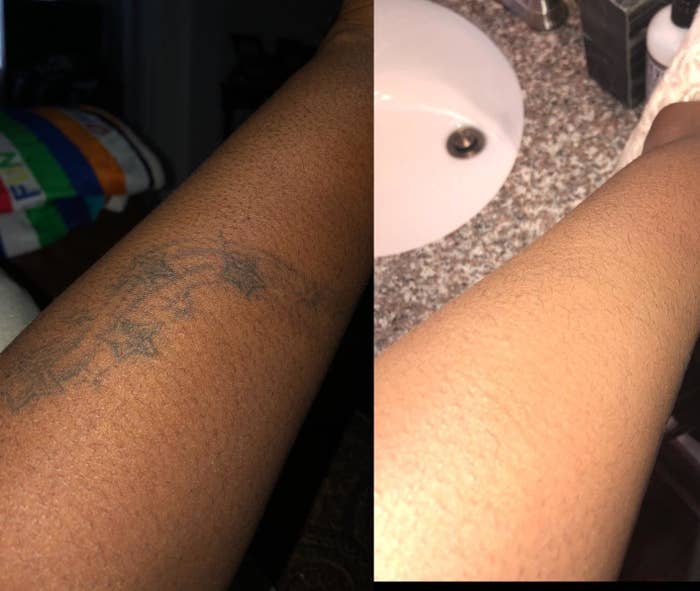 before: arm with tattoos after: no visible tattoos