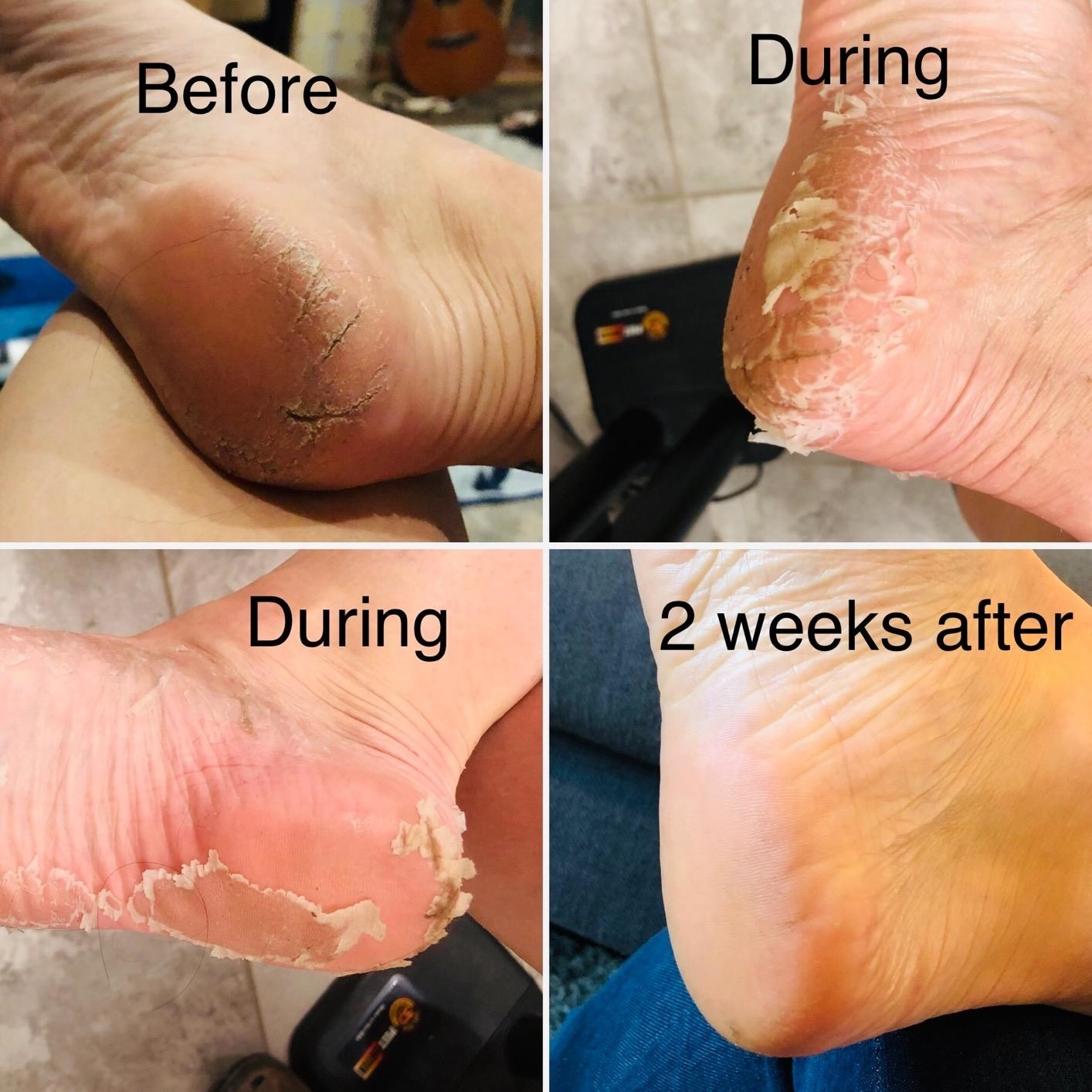 A before/during after photo showing how the baby foot helped cracked feet